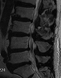 Lumbar Stenosis MRI Sagittal